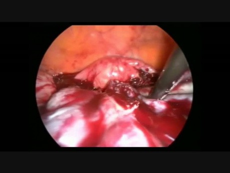Laparoscopy for Bilateral Ovarian Metastatic Masses