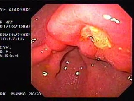 Gastric Ulcer of Pre-pyloric Antrum (1 of 2)