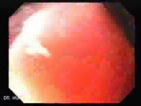 Gastric Cancer - Intestinal Metaplasia - Endoscopy (1 of 7)