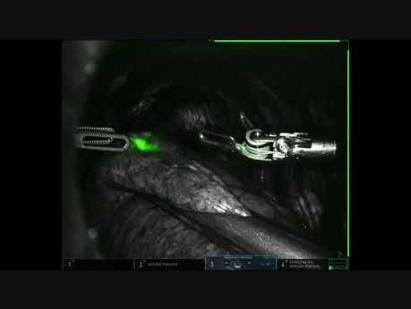 Lung Marker and Green Indocianinm, Lung Nodule