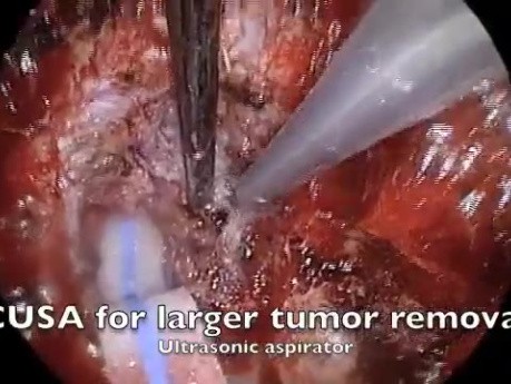 Endoscopic Removal of Olfactory Meningoma