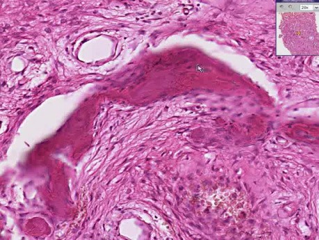 Bone - Fibrous Dysplasia