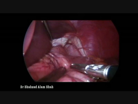 Sleeve Gastrectomy