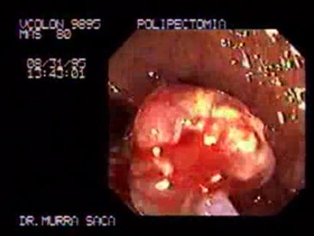 Enormous Sessile Adenoma of the Rectum (2 of 2)