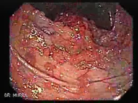 Familial Adenomatous Polyposis (14 of 36)