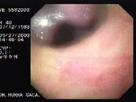 Acute Variceal Bleeding - Banding of Esophageal Varices
