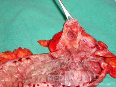 Severe case of Ischemic Colitis (17 of 19)