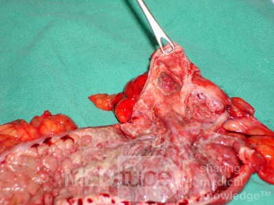 Severe case of Ischemic Colitis (17 of 19)