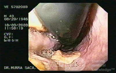Acute Variceal Bleeding - Retroflexed View of Gastric Cardias in Assessment of Ligation