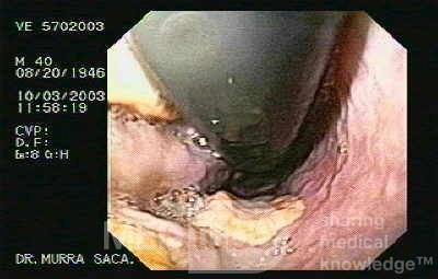 Acute Variceal Bleeding - Retroflexed View of Gastric Cardias in Assessment of Ligation
