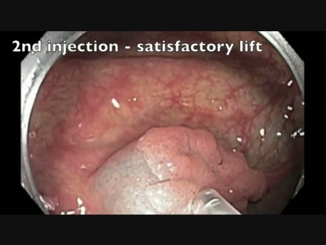 Colon EMR Perforation Analysis-C
