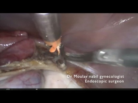 Adnexectomy for Ovarian Fibroma
