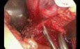Trans-axillary Thyroidectomy