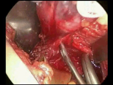 Trans-axillary Thyroidectomy