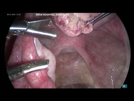 Laparoscopic Myomectomy 1 Lateral Wall Fibroid