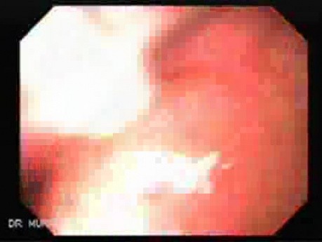 Endoscopy of Mallory Weiss Tear - Source of Bleeding