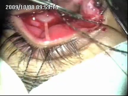 Management of Congenital Anomaly - Cryptophthalmos