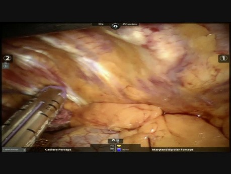 Robotic Middle Lobectomy