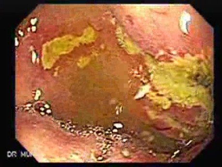 Duodenal Ulcers (2 of 4)
