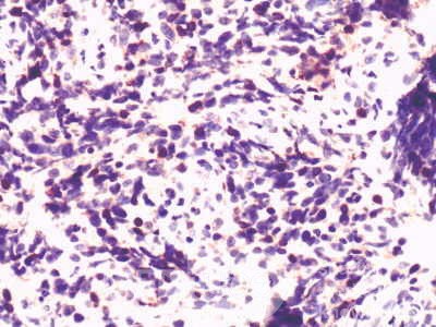 Non-Hodking Lymphoma B Cells. MALT (mucosa associated lymphoid tissue) (7 of 7)