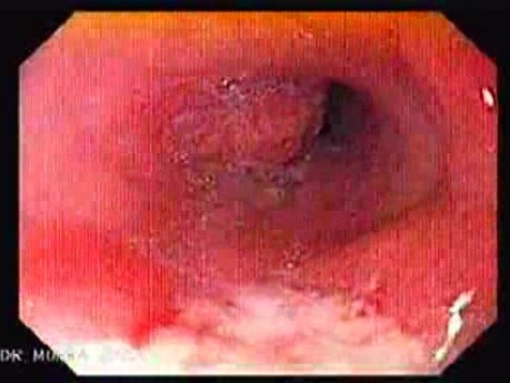 Severe Esophageal Ulcer - Esophagoscopy
