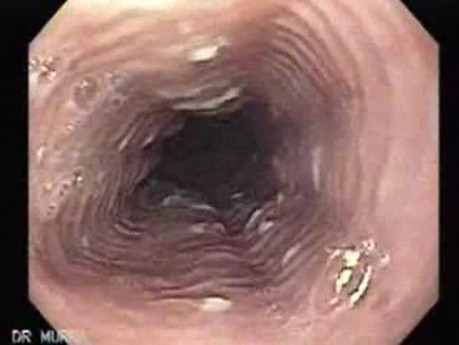 Candida Esophagitis - Endoscopy - Characteristic Appearance