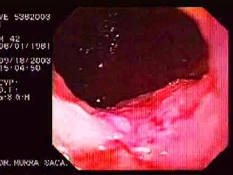 Pseudoachalasia - Suspicion of Neoplastic Infiltration