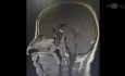 Transseptal Trans Sphenoidal Approach for Resection of a Sellar Suprasellar Lesion
