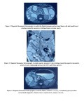 Incomplete Jejunoileal Junction Atresia Chronic Midgut Volvulus
