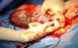 Nuchal Cord (Four Turns of the Umbilical Cord)