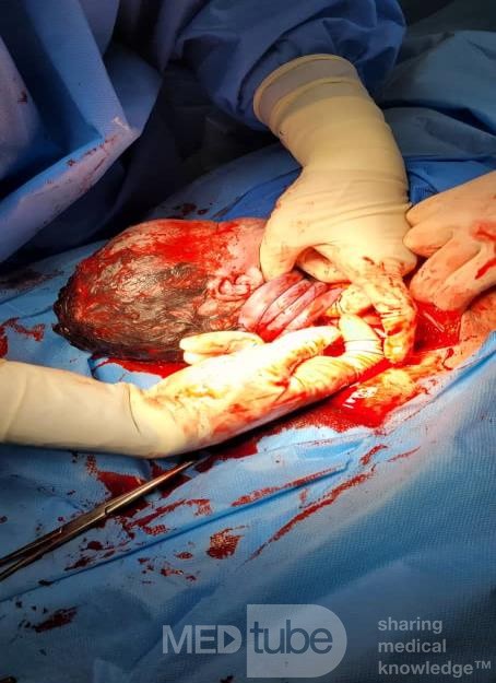 Nuchal Cord (Four Turns of the Umbilical Cord)