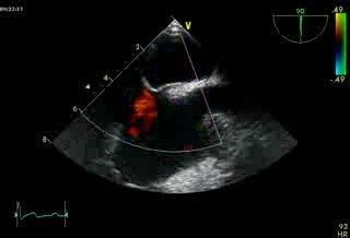 Patent Foramen Ovale (PFO)