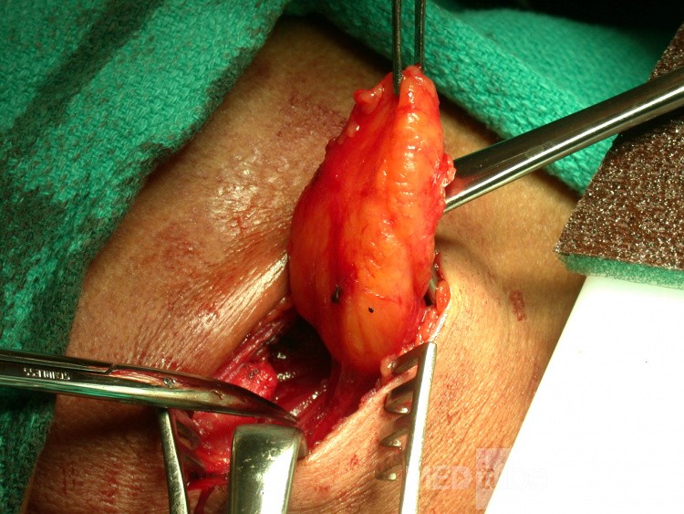 Neck Lipoma