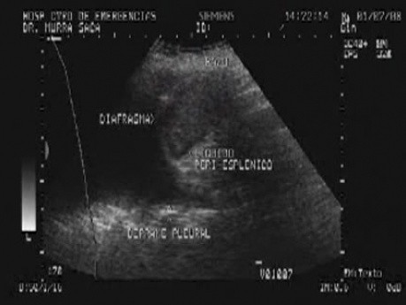 Ovarian Carcinoma with Gastric and Duodenal Metastases  - Suspicion of Meigs Syndrome