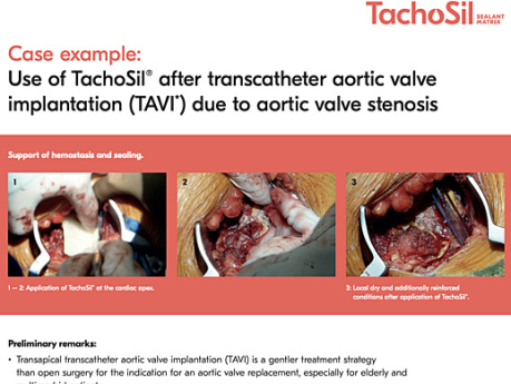 Use of TachoSil® for Efficient Haemostasis and Sealing After Transcatheter Aortic Valve Implantation (TAVI) Due to Aortic Valve Stenosis, Prof. Martin Czerny