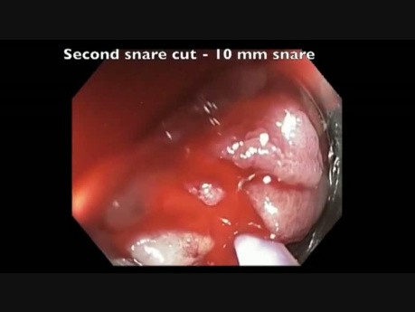 Colonoscopy Goes Awry - Cecal EMR Bleed - clip C