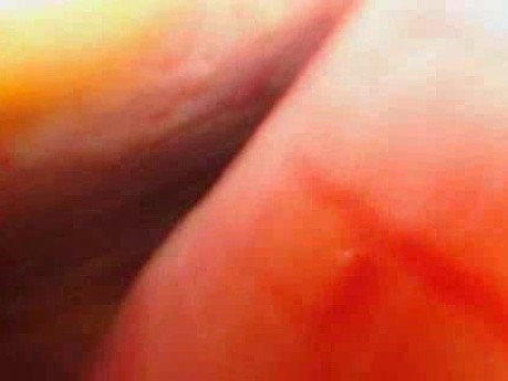Colonic Perforation With Peritonitis - Laparoscopy (23 of 46)