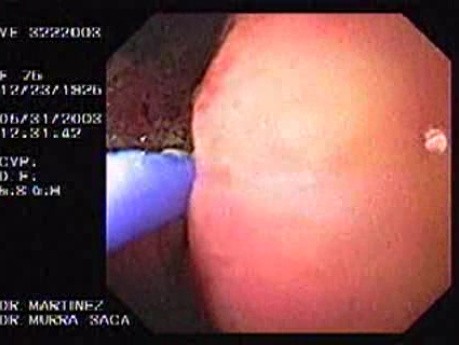 Upper Gastrointestinal Bleeding (9 of 15)