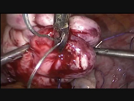 Myomectomy in Postwall Fibroid