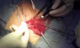Inguinal hernia repair with semiabsorbable mesh