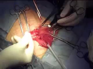 Inguinal hernia repair with semiabsorbable mesh
