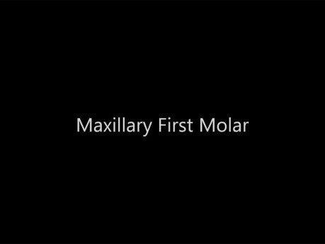 Maxillary First Molar - Root Canal Anatomy