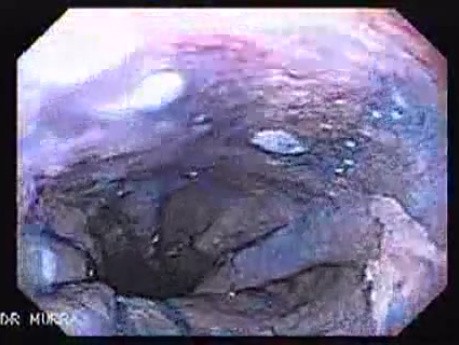 Barrett Esophagus (6 of 6)