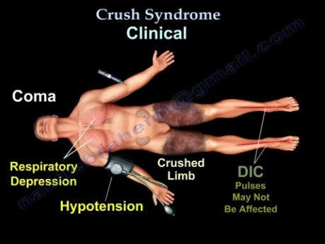 Crush Syndrome 
