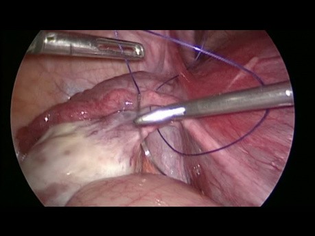 Recurrent Ovarian Torsion Oophropexy in Pregnancy
