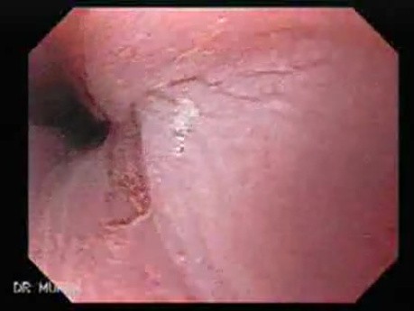 Barrett's Esophagus of long segment (7 of 24)