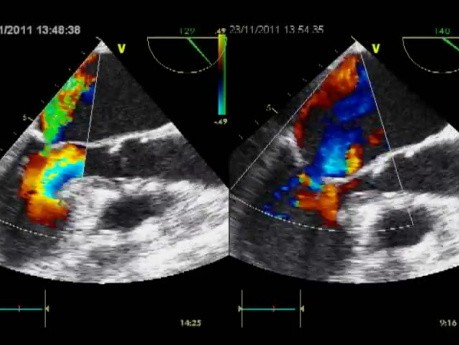 Eclipsed Functional Mitral Regurgitation as a Main Cause of Acute Pulmonary Oedema