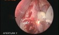 Endoscopic Dacrio-Cisto-Rhinostomy with Masupialization Sac