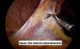 Laparoscopic Ileo-cecal Resection: A Step-by-Step Video Vignette