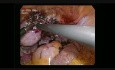 Right Cornual Pregnancy Lap Surgery